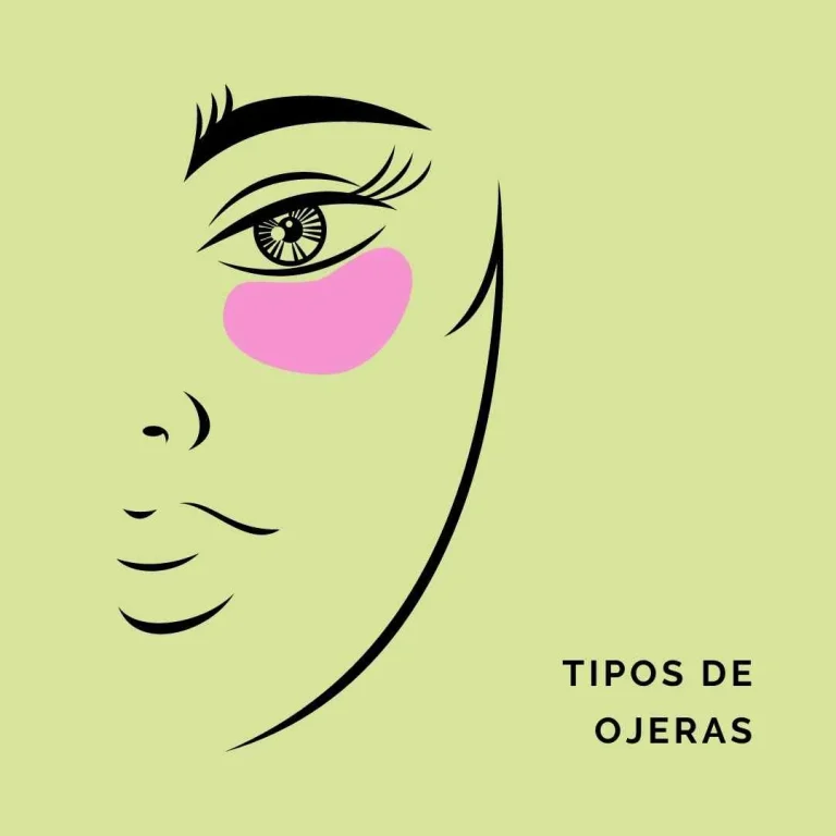 Los tipos de ojeras