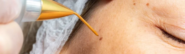 Tratamiento de Plasma Láser en Clínica Reviure