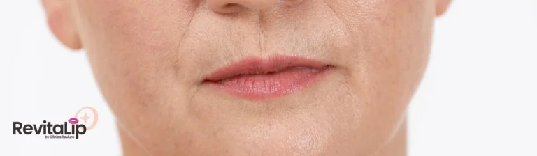 Tratamiento de RevitaLip Plus en Clínica Reviure